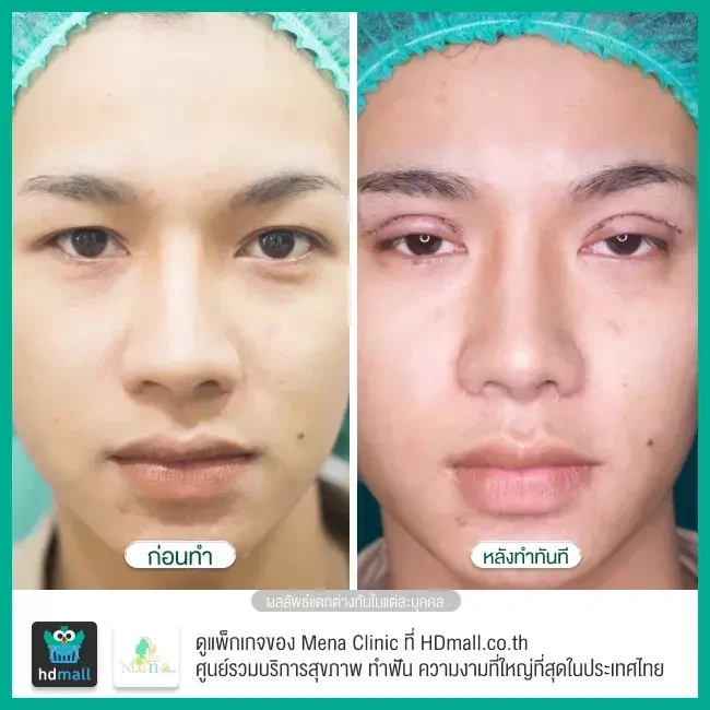 Before After รีวิว ทำตาสองชั้นแบบกรีดยาว พร้อมตกแต่งไขมัน ที่ Mena Clinic