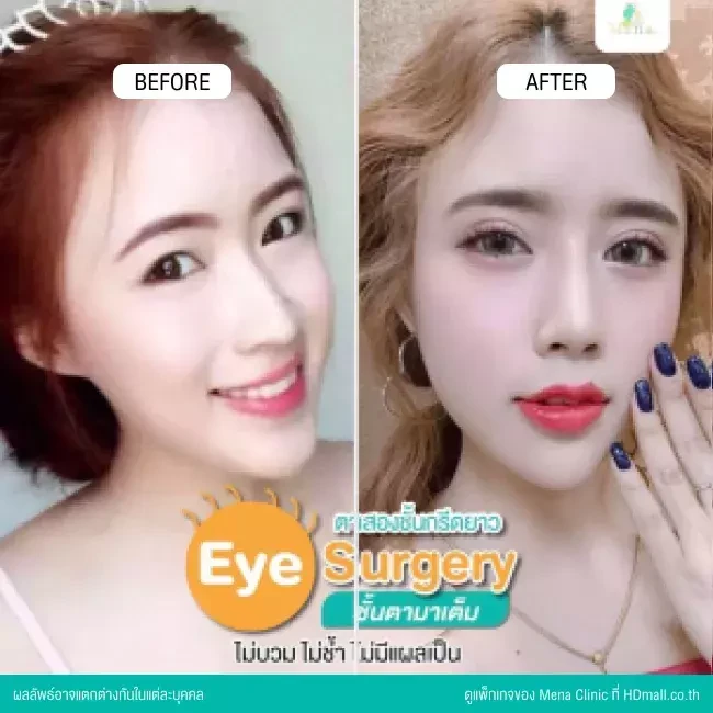 รีวิว ทำตาสองชั้นแบบกรีดยาว พร้อมตกแต่งไขมัน ที่ Mena Clinic