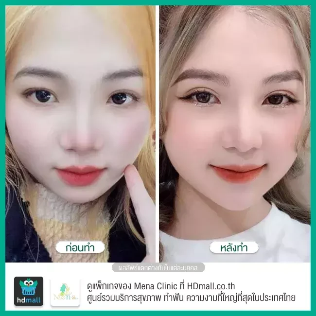 Before After รีวิว ทำตาสองชั้นแบบกรีดยาว พร้อมตกแต่งไขมัน ที่ Mena Clinic