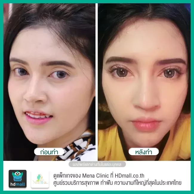 Before After รีวิว ทำตาสองชั้นแบบกรีดยาว พร้อมตกแต่งไขมัน ที่ Mena Clinic