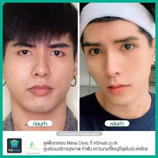 Before After รีวิว ทำตาสองชั้นแบบกรีดยาว พร้อมตกแต่งไขมัน ที่ Mena Clinic