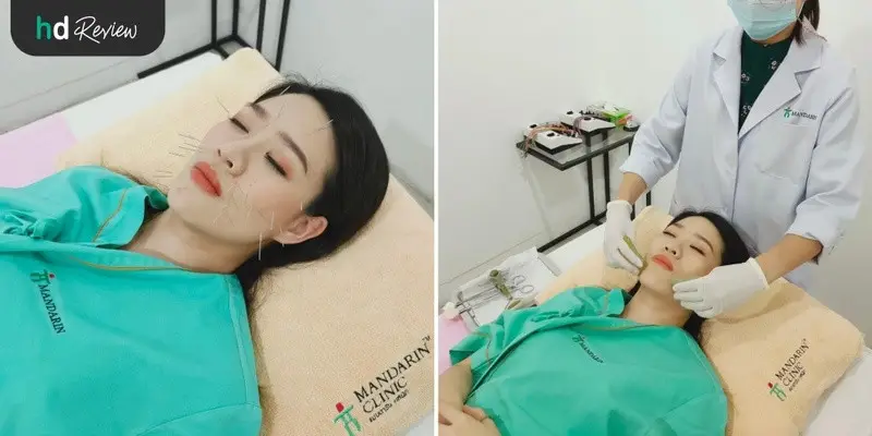 รีวิวฝังเข็ม กัวซา หน้าใสอมชมพู ที่ แมนดารินคลินิก