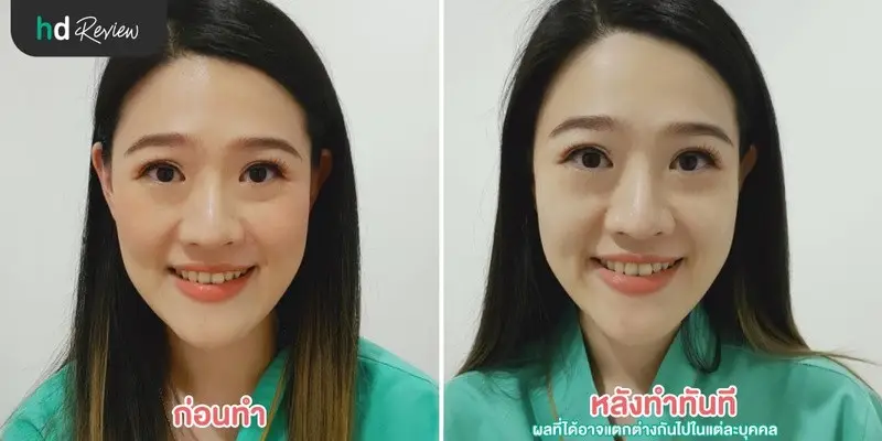 รีวิวฝังเข็ม กัวซา หน้าใสอมชมพู ที่ แมนดารินคลินิก