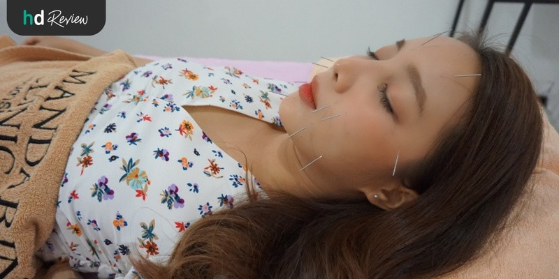 รีวิว ฝังเข็ม ทรีตเมนต์กัวซา ที่ แมนดารินคลินิก