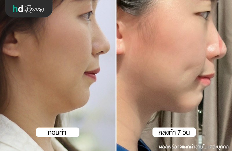 รีวิว Cryo V สลายไขมันเหนียงด้วยความเย็น ที่ Wink Clinic