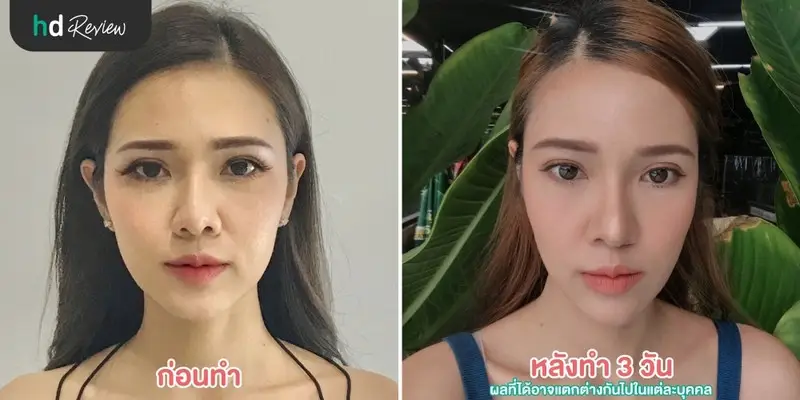 รีวิว ฉีดฟิลเลอร์คาง Neuramis ที่ Zenzen Clinic