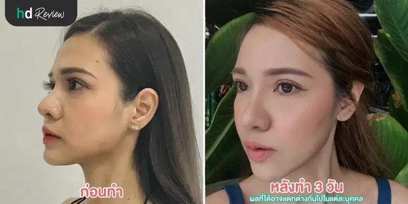 รีวิว ฉีดฟิลเลอร์คาง Neuramis ที่ Zenzen Clinic