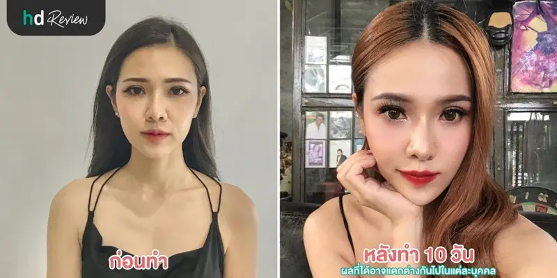 content review filler injection neuramis 1 cc chin at zen zen clinic by neeranara boonchuai 7