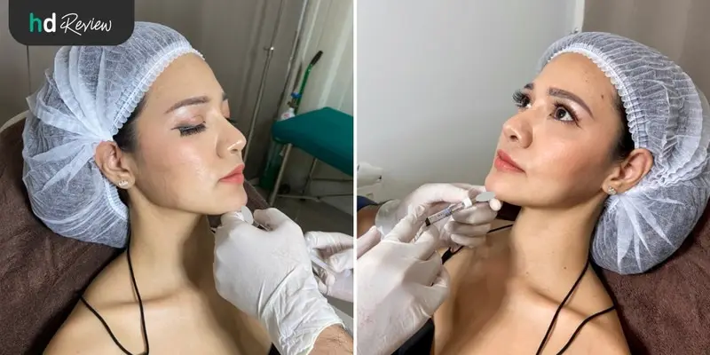 content review filler injection neuramis 1 cc chin at zen zen clinic by neeranara boonchuai 9