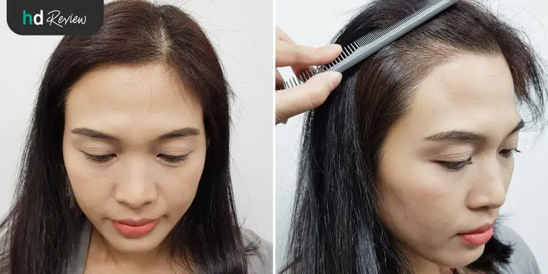 ผลลัพธ์หลังจากทำเลเซอร​์กระตุ้นรากผม ครั้งที่ 3 ที่ GROW & GLOW Clinic