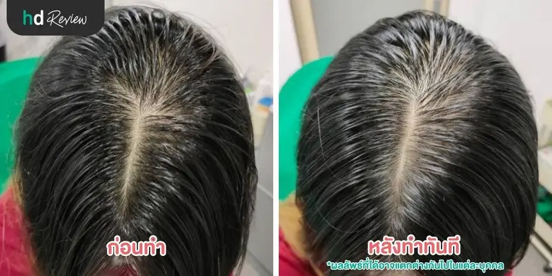 หยุดการจากลาของเส้นผมด้วยเลเซอร์ Hair Growth ที่ GROW & GLOW Clinic 9 ภาพก่อนและหลังทำเลเซอร์กระตุ้นรากผม หยุดการผมร่วง ที่ Grow & Glow Clinic