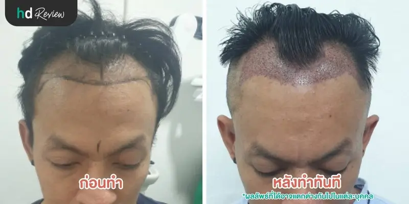 ภาพก่อนทำและหลังทำทันที