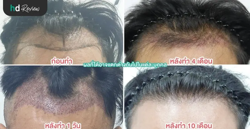 ภาพเปรียบเทียบก่อนทำ หลังทำ 1 วัน 4เดือน และ 10 เดือน