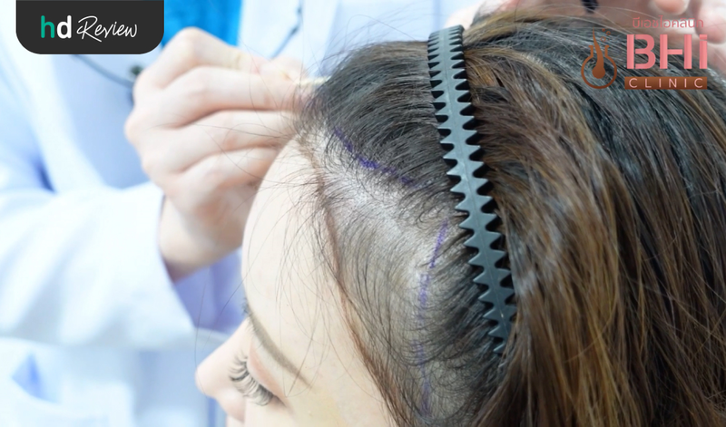 การเตรียมตัวก่อนปลูกผมแบบ FUE ที่ BHI Clinic