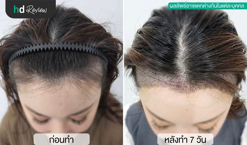 เปรียบเทียบก่อนและหลังปลูกผมแบบ FUE ที่ BHI Clinic