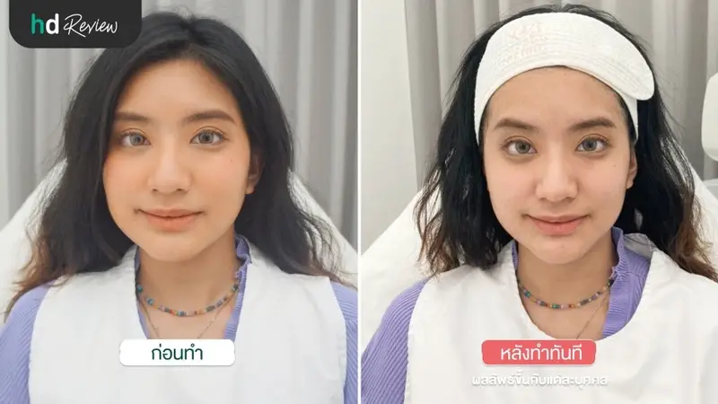 content review hifu ultraformer and botulinum toxin injections korea nabota at merry clinic by parima chandakorn 16