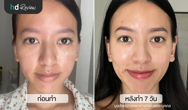 เปรียบเทียบก่อนและหลังทำ Ultraformer III ที่ B Clinic