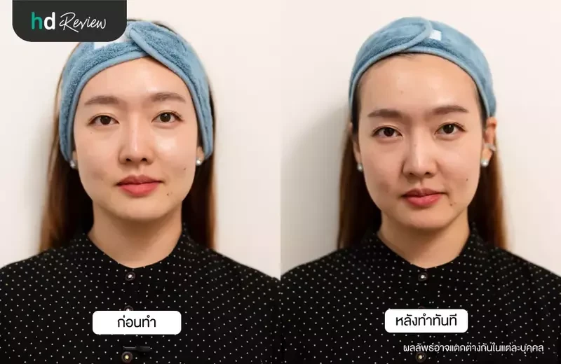 Before After ทำ Ultraformer III ที่ KAYA Alternative Polyclinic
