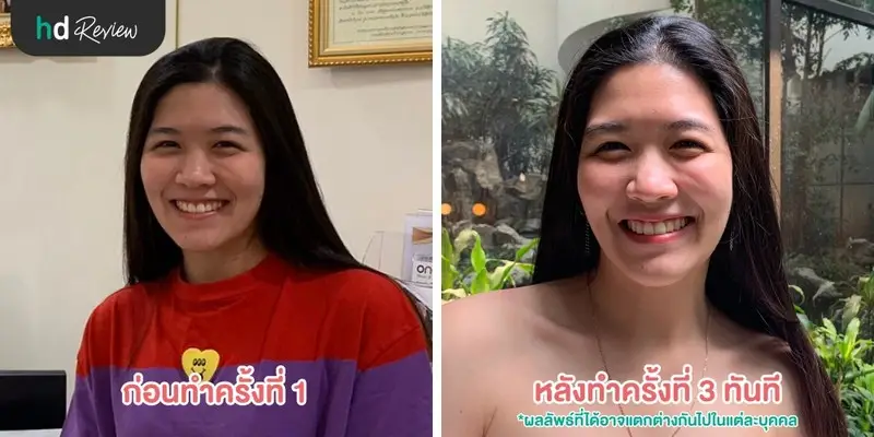 ครั้งแรกในชีวิต รีวิว ทรีตเมนต์ให้หน้าฉ่ำวาวเหมือนสาวเกาหลี ที่ Millennium Anti Aging Clinic 10 ภาพ Before After การทำทรีตเมนต์ ที่ Millennium Anti Aging Clinic