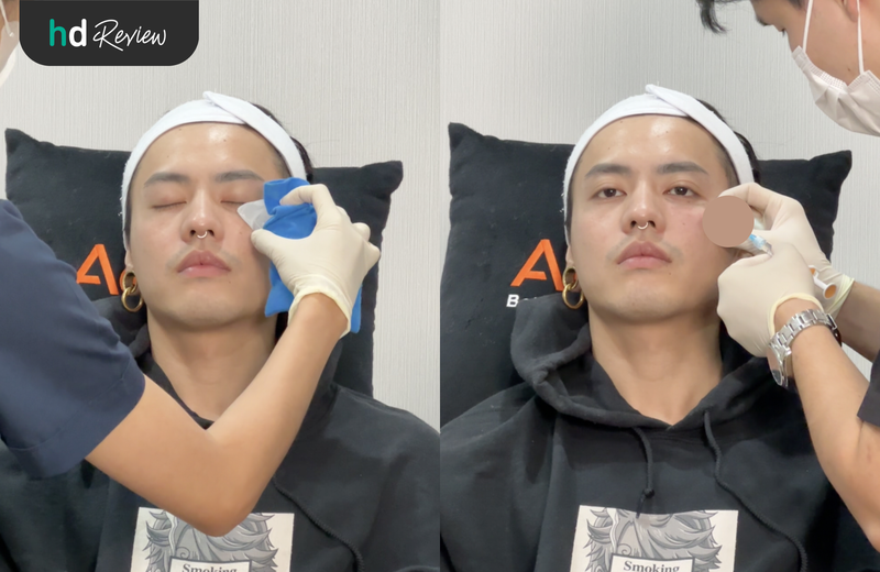ขั้นตอนการฉีดฟิลเลอร์ใต้ตา