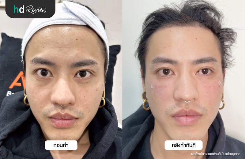 ผลลัพธ์หลังฉีดฟิลเลอร์ใต้ตา