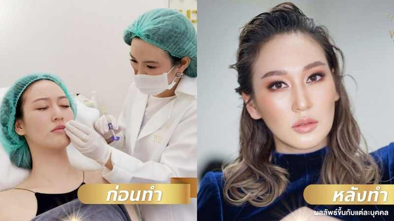 content review injectable fillers juvederm temples and lips at wink clinic by paranya lapudomsakul 5