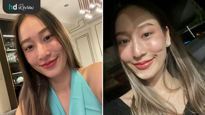 content review injectable fillers juvederm temples and lips at wink clinic by paranya lapudomsakul 6