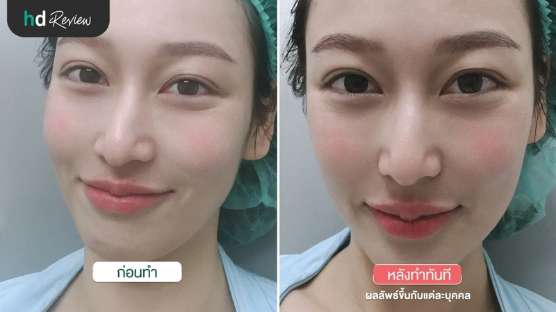 content review injectable fillers juvederm temples and lips at wink clinic by paranya lapudomsakul 7