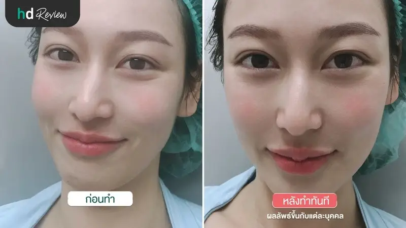 content review injectable fillers juvederm temples and lips at wink clinic by paranya lapudomsakul 7