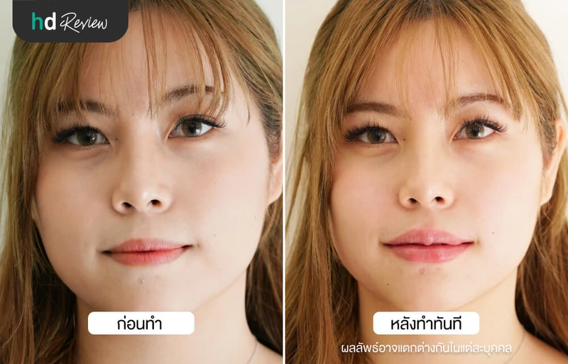 ภาพ Before After เปรียบเทียบก่อนหลังฉีดฟิลเลอร์ปากกระจับ ที่ YNC Clinic