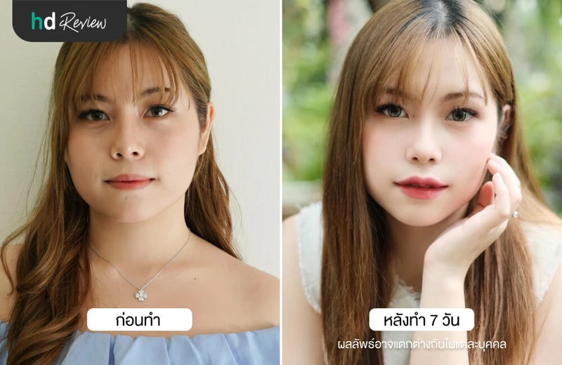 ภาพ Before After เปรียบเทียบก่อนหลังฉีดฟิลเลอร์ปากกระจับ ที่ YNC Clinic