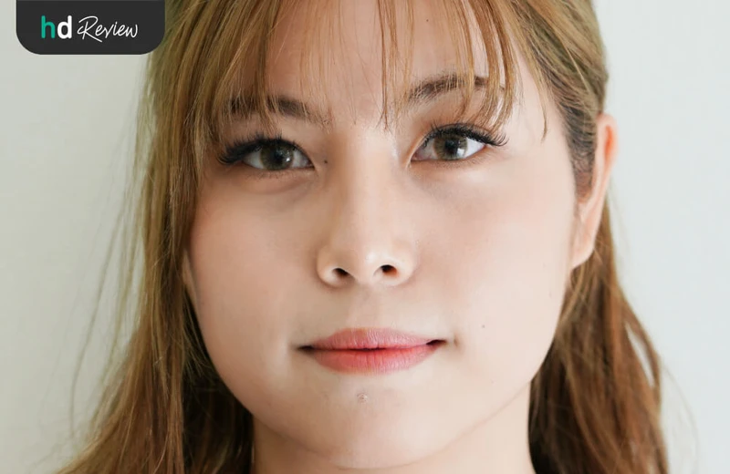 รูป Before ก่อนฉีดฟิลเลอร์ปากกระจับ ที่ YNC Clinic