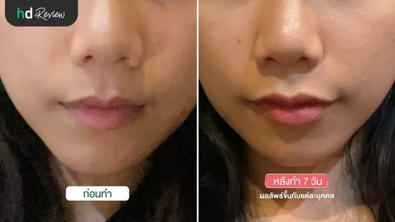 เปรียบเทียบ ก่อนฉีดฟิลเลอร์ปาก และหลังฉีดฟิลเลอร์ปาก 7 วัน