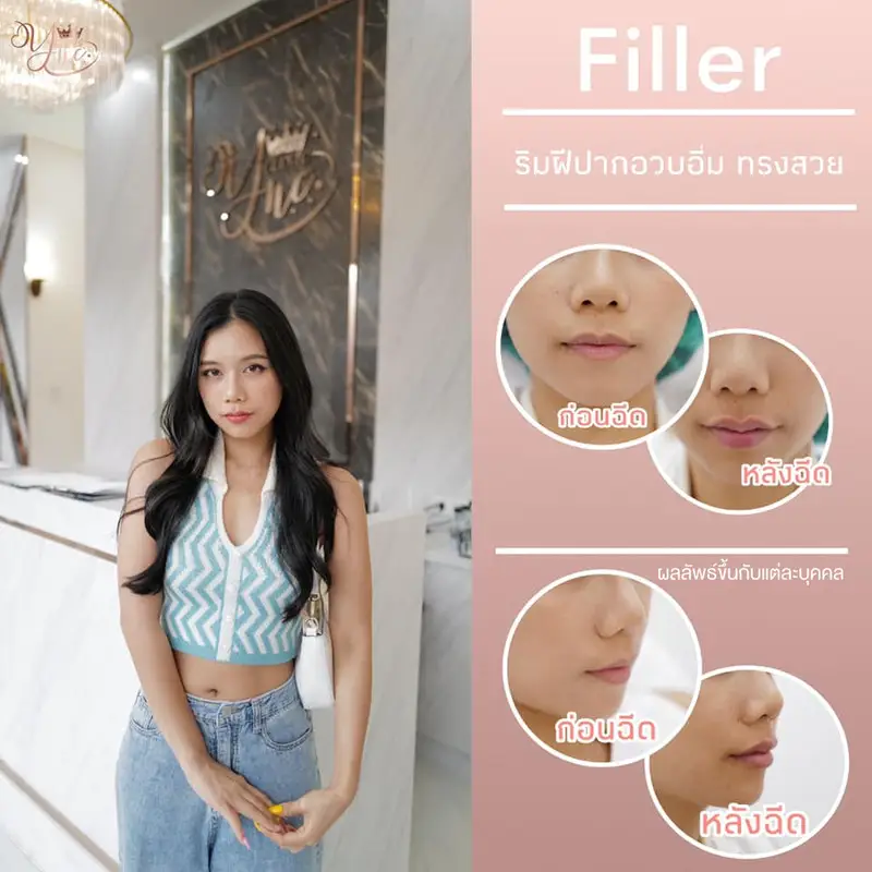 ฉีดฟิลเลอร์ Neuramis 1 ซีซี บริเวณที่มีปัญหา 1 ครั้ง ที่ YNC Clinic
