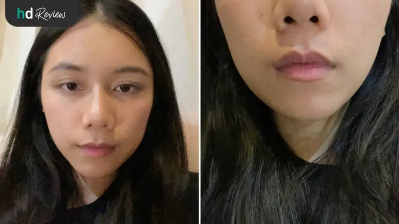 ปากของฉัน ก่อนฉีดฟิลเลอร์ปาก ที่ YNC Clinic