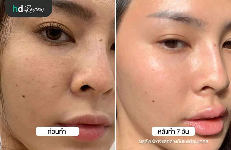 เปรียบเทียบผลลัพธ์ฉีดโบท็อกซ์รูขุมขน ที่ เฌอฌาร์มคลินิก