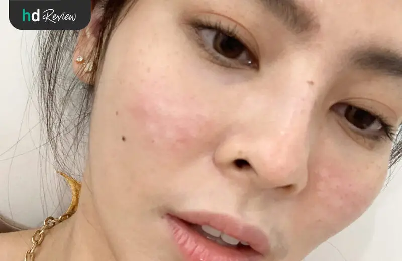 รีวิว หลังฉีดโบท็อกซ์รูขุมขน ที่ เฌอฌาร์มคลินิก