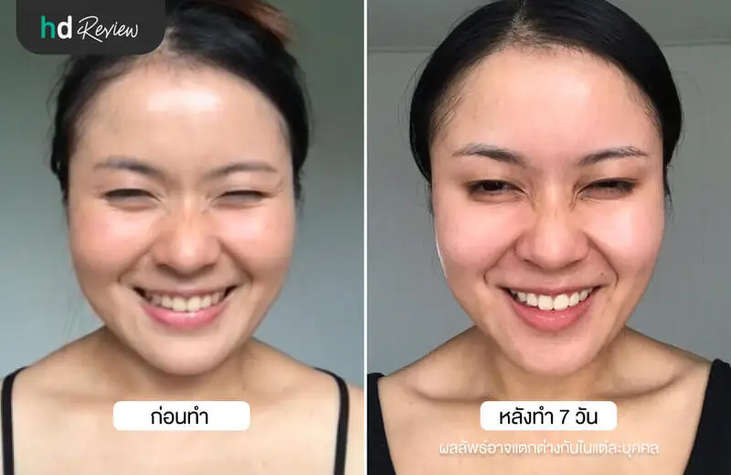ผลลัพธ์หลังฉีดโบท็อกซ์ลดริ้วรอย ที่ เฌอฌาร์มคลินิก