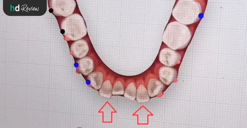 ภาพ 3D อธิบายการทำ Invisalign ที่ Deezy Dental Home