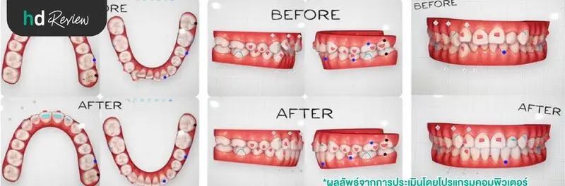 รีวิวจัดฟันแบบใส Invisalign Full ทั้งฟันบนและฟันล่าง