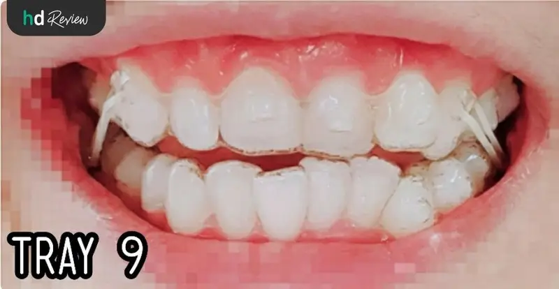 ใส่ชิ้นงานจัดฟันแบบใส Invisalign Full ทั้งฟันบนและฟันล่าง