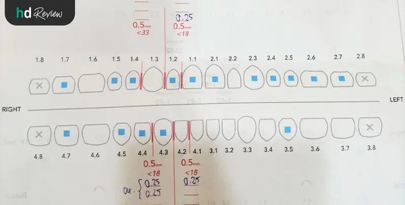 แผนการจัดฟันแบบใส Invisalign Full ทั้งฟันบนและฟันล่าง