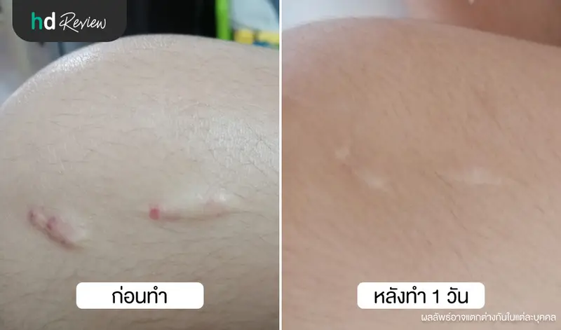 เปรียบเทียบรูปภาพก่อนและหลังฉีดรักษาแผลเป็นคีลอยด์ ที่ คลินิกผิวหนังประดิพัทธ์