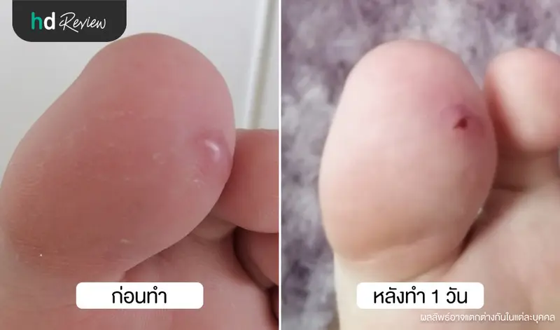 เปรียบเทียบรูปภาพก่อนและหลังฉีดรักษาแผลเป็นคีลอยด์ ที่ คลินิกผิวหนังประดิพัทธ์