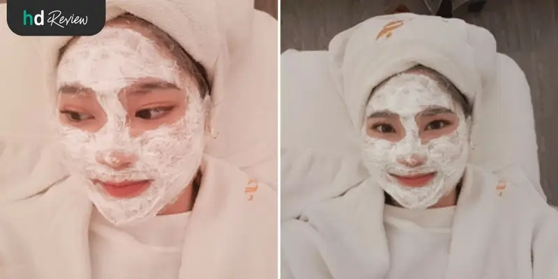 ขั้นตอนการเลเซอร์รักษารอยแผลเป็นจากสิวและหลุมสิวครั้งที่ 2 ที่ The Sign Clinic