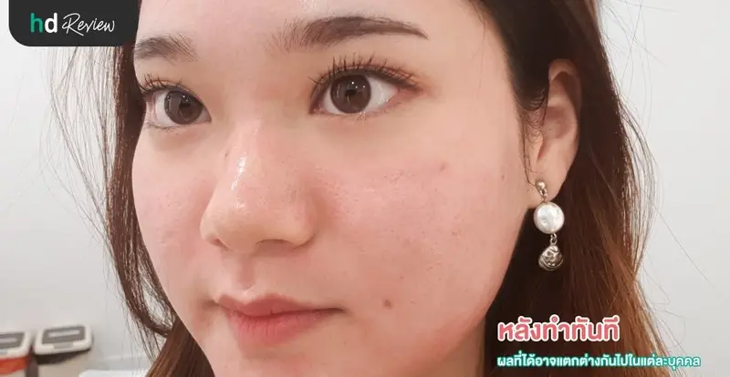 หลังทำเลเซอร์รักษารอยแผลเป็นจากสิวและหลุมสิวครั้งที่ 2
