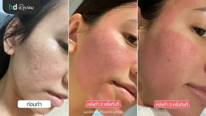 ภาพผลลัพธ์หลังรักษาหลุมสิวด้วยเลเซอร์ FINE SCAN 1550 ที่ Clinic Neo