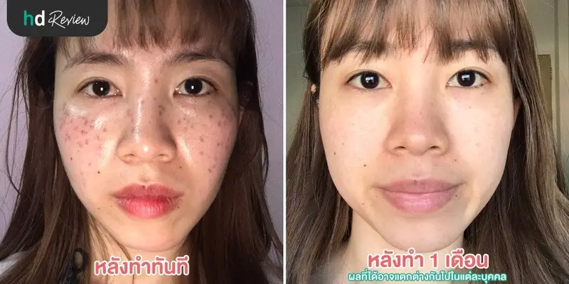 ภาพผลลัพธ์หลังทำเลเซอร์ ฝ้า กระ ด้วย Pico Way ที่ The Sign Clinic