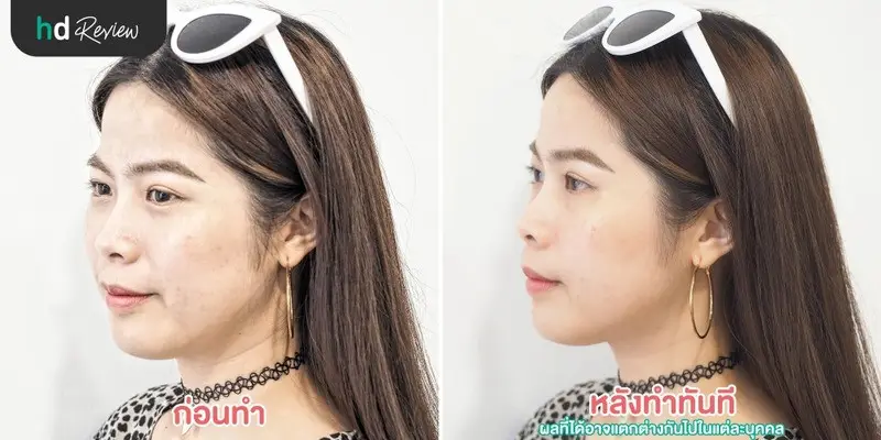 รีวิว PicoWay Melasma รักษาฝ้าและกระ ที่ The Sign Clinic