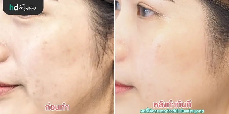 รีวิว PicoWay Melasma รักษาฝ้าและกระ ที่ The Sign Clinic
